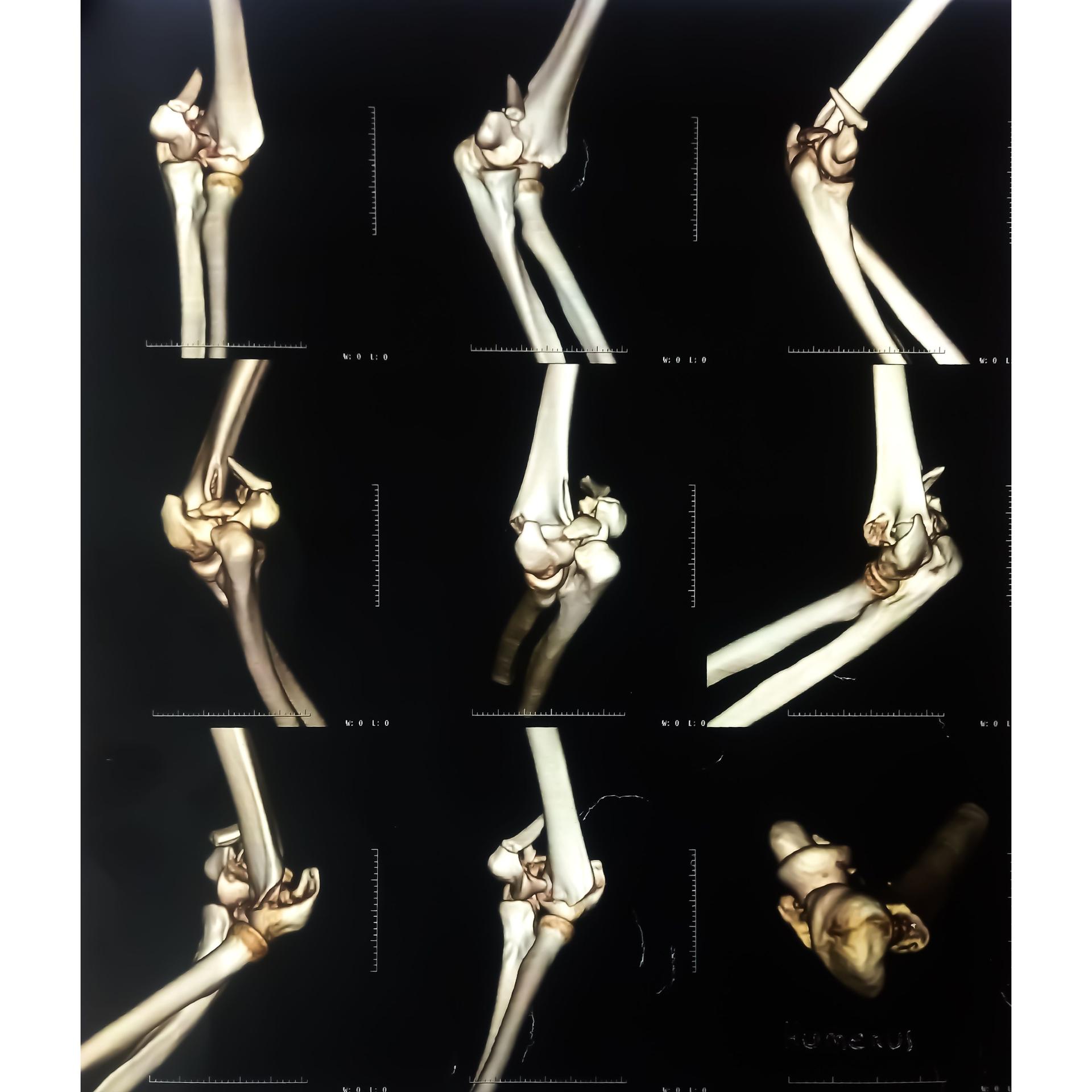 CT scan 3D image of an elbow joint showing dislocation and fracture after an accident female patient. film x-ray. medical concept.
